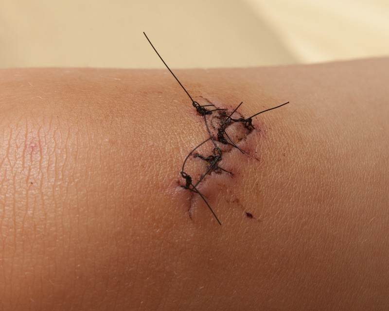 suture technique