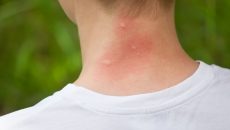 mosquito bites