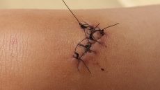 suture-technique